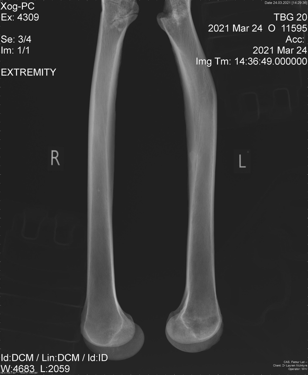 healed spiral fracture in the left thigh